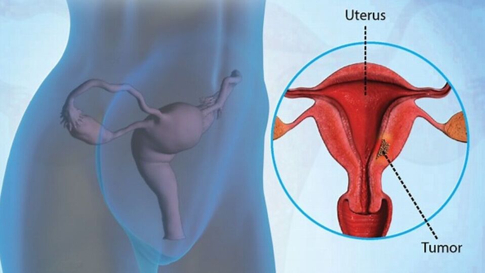 Uterine Cancer : கருப்பை புற்றுநோய் என்றால் கலங்க வேண்டாம் - அறிகுறி, நோய் கண்டறிதல், சிகிச்சை என்ன தெரிந்துகொள்ளுங்கள்!