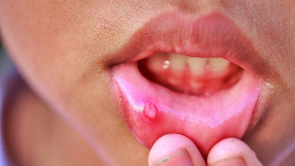 mouth-ulcer-how-to