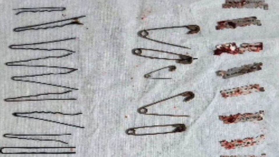 Viral: இளைஞரின் வயிற்றுக்குள் 13 ஹேர் பின்கள், 5 ஊக்குகள்..ஷாக்கான மருத்துவர்கள்!