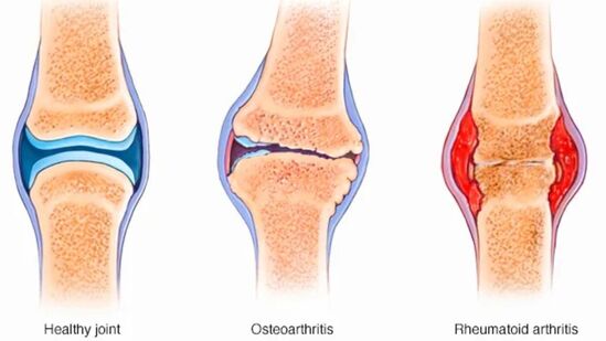 Tips to Strengthen Knees : ஆர்த்தரிட்டிஸ் நோயால் அச்சமா? மூட்டுகளில் வலியா? கவலை வேண்டாம்! இதோ தீர்க்கும் வழிகள்!