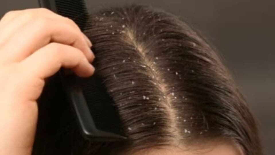 Dandruff Issues : பொடுகுத் தொல்லையால் அவதிப்படுகிறீர்களா? வீட்டிலே செய்யக்கூடிய இத்தனை எளிய தீர்வுகளா?