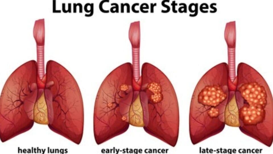 World Cancer Day 2024   Lung Cancer 1706977422879 1706977437377 