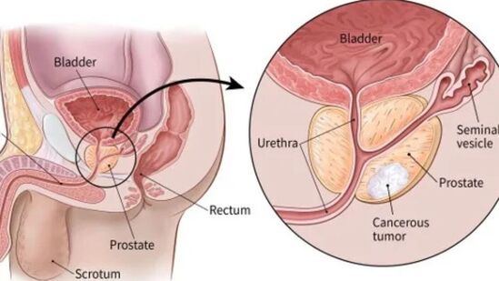 ப்ராஸ்டேட் புற்றுநோய் - ஸ்பெர்ம்களை கடத்தும் ப்ராஸ்டேட் என்ற உறுப்பில் ஏற்படுகிறது. சிறுநீர் கழிப்பதில் சிரமம், சிறுநீர் அதிகமாக வெளியேறுவது, சிறுநீரில் ரத்தம், விந்தணுவில் ரத்தம், எலும்பு வலி, உடல் உடை குறைவு, ஆணுறுப்பு விரைத்தலில் குறைபாடு இந்த அறிகுறிகள் தொடர்ந்து தென்பட்டால் உடனே மருத்துவரை அணுகவேண்டும்.