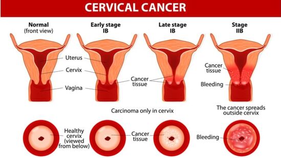 Cervical Cancer Symptoms : எச்சரிக்கை பெண்களே இந்த பிரச்னைகள் இருந்தால் கவனம்! கருப்பைவாய் புற்றுநோயாக இருக்கலாம்!