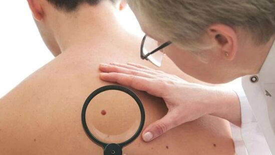 Moles Formation : உங்கள் உடலில் இப்படியெல்லாம் மச்சம் உள்ளதா? அதனால் என்ன நடக்கும் தெரியுமா? Moles Formation : உங்கள் உடலில் இப்படியெல்லாம் மச்சம் உள்ளதா? அதனால் என்ன நடக்கும் தெரியுமா?