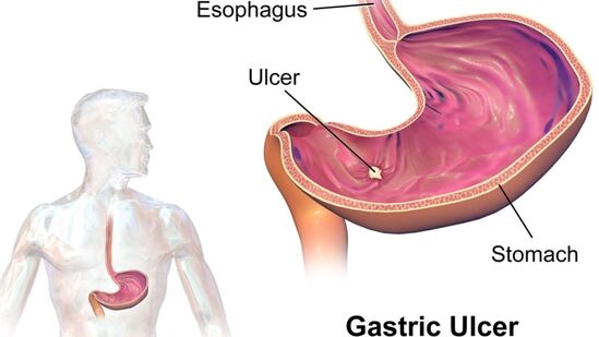 Ulcer Home Remedy : கடும் அல்சரால் அவதிப்படுகிறீர்களா? அதற்கு ஏலக்காயை என்ன செய்து சாப்பிட வேண்டும் பாருங்கள்! Ulcer Home Remedy : கடும் அல்சரால் அவதிப்படுகிறீர்களா? அதற்கு ஏலக்காயை என்ன செய்து சாப்பிட வேண்டும் பாருங்கள்!