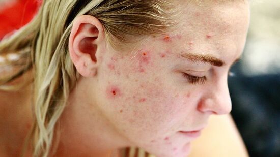 Pregnancy acne: கர்ப்ப காலத்தில், ஒரு பெண்ணின் உடலில் மட்டுமல்ல, அவளது உடலில் வெளிப்புறமாகவும் மாற்றங்கள் ஏற்படுகின்றன. கருவின் அளவு அதிகரிக்கும் போது, அடிவயிறு மற்றும் அதைச் சுற்றியுள்ள பகுதிகளில் நீட்டிக்க மதிப்பெண்கள் தோன்றத் தொடங்குகின்றன, எடை அதிகரிக்கத் தொடங்குகிறது, எனவே பல பெண்களும் முகப்பரு மற்றும் சிறு புள்ளிகளைப் பற்றி புகார் கூறுகிறார்கள். லட்சக்கணக்கான முயற்சிகள் மற்றும் அனைத்து வகையான வசதிகளும் இருந்தபோதிலும் இந்த பிரச்சினைகள் அனைத்தும் உங்களால் தவிர்க்க முடியாதவை. அவை உங்கள் தன்னம்பிக்கையை பாதிக்க அனுமதிப்பதற்குப் பதிலாக, அவை தாய்மையின் பரிசாக ஏற்றுக்கொள்ளப்பட்டால், தாயாகும் பயணம் மகிழ்ச்சியாக மாறும்.