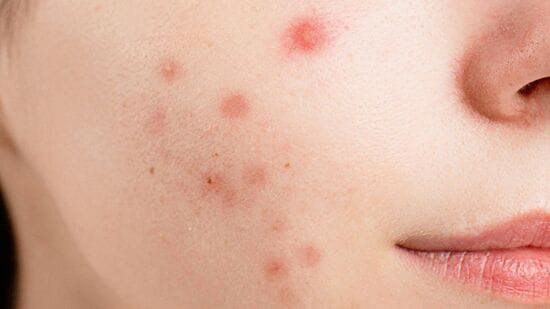 Pregnancy acne: வழக்கமாக, சருமத்தின் சுகாதாரம் கவனிக்கப்படாவிட்டால், எண்ணெய், அழுக்கு, இறந்த சருமம் மற்றும் சருமம் ஆகியவற்றின் அடுக்கு அதன் மீது சேரத் தொடங்குகிறது, இதன் காரணமாக துளைகள் மூடப்பட்டு முகப்பரு பிரச்சினைகள் ஏற்படுகின்றன. அடைபட்ட துளைகள் பாக்டீரியாக்கள் வளர சாதகமான நிலைமைகளை உருவாக்குகின்றன, இதனால் சருமத்தில் பிளாக்ஹெட்ஸ், வைட்ஹெட்ஸ் மற்றும் முகப்பரு பிரச்சினைகள் ஏற்படுகின்றன என்று ஆராய்ச்சி கூறுகிறது. ஆனால் கர்ப்ப காலத்தில் ஹார்மோன்கள், மன அழுத்தம், உணவு மற்றும் மருந்துகளில் ஏற்படும் மாற்றங்கள் காரணமாக, கர்ப்பிணிப் பெண்ணின் முதுகு, கழுத்து மற்றும் நெற்றியிலும் முகப்பரு ஏற்படலாம். கர்ப்ப காலத்தில், ஈஸ்ட்ரோஜன் ஹார்மோனின் அளவு உடலில் அதிகரிக்கிறது, இதனால் எண்ணெய் சுரப்பிகள் அதிக எண்ணெயை உற்பத்தி செய்கின்றன.