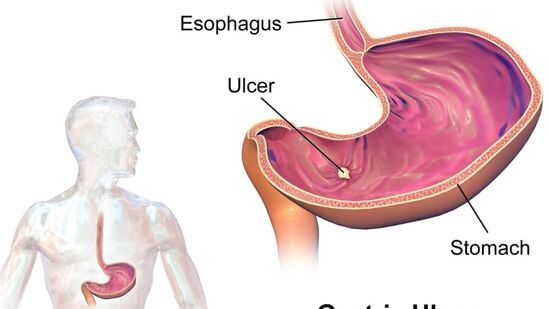 Ulcer Home Remedies : அல்சர் பிரச்னையால் அவதியா? இதோ வீட்டிலேயே செய்யக்கூடிய எத்தனை எளிய தீர்வுகள் பாருங்க!