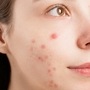 <p>Pregnancy acne: வழக்கமாக, சருமத்தின் சுகாதாரம் கவனிக்கப்படாவிட்டால், எண்ணெய், அழுக்கு, இறந்த சருமம் மற்றும் சருமம் ஆகியவற்றின் அடுக்கு அதன் மீது சேரத் தொடங்குகிறது, இதன் காரணமாக துளைகள் மூடப்பட்டு முகப்பரு பிரச்சினைகள் ஏற்படுகின்றன. அடைபட்ட துளைகள் பாக்டீரியாக்கள் வளர சாதகமான நிலைமைகளை உருவாக்குகின்றன, இதனால் சருமத்தில் பிளாக்ஹெட்ஸ், வைட்ஹெட்ஸ் மற்றும் முகப்பரு பிரச்சினைகள் ஏற்படுகின்றன என்று ஆராய்ச்சி கூறுகிறது. ஆனால் கர்ப்ப காலத்தில் ஹார்மோன்கள், மன அழுத்தம், உணவு மற்றும் மருந்துகளில் ஏற்படும் மாற்றங்கள் காரணமாக, கர்ப்பிணிப் பெண்ணின் முதுகு, கழுத்து மற்றும் நெற்றியிலும் முகப்பரு ஏற்படலாம். கர்ப்ப காலத்தில், ஈஸ்ட்ரோஜன் ஹார்மோனின் அளவு உடலில் அதிகரிக்கிறது, இதனால் எண்ணெய் சுரப்பிகள் அதிக எண்ணெயை உற்பத்தி செய்கின்றன.</p>