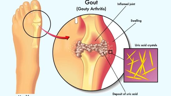 Uric Acid Home Remedy : யூரிக் அமிலப்பிரச்னையால் அவதியா? இதோ இந்த ஒரு ஜூஸ் மட்டும் போதும்! Uric Acid Home Remedy : யூரிக் அமிலப்பிரச்னையால் அவதியா? இதோ இந்த ஒரு ஜூஸ் மட்டும் போதும்!