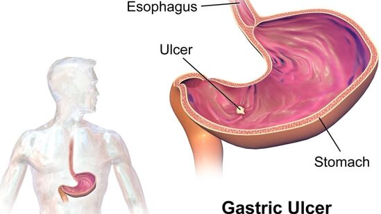 Ulcer Remedy : அல்சரைப் போக்கும் அருமருந்தாக நமது வீட்டு சமையலறையிர் உள்ள விரலி மஞ்சளும், சமையலறையில் உள்ள இரண்டு பொருட்கள் மட்டும் போதும். உங்களுக்கு இன்னுமொரு டிப்ஸ்ம் கொடுக்கப்பட்டுள்ளது.