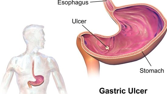 Ulcer Home Remedy : அலசர் மற்றும் வாய் துர்நாற்றம் இரண்டையும் அடித்து விரட்டும் அருமருந்தை நீங்கள் வீட்டிலே செய்ய முடியும்.