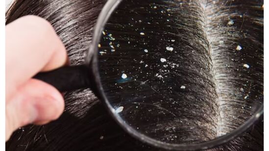 Dandruff Remedies : பொடுகு தொல்லையால் அவதியா? பொடுகுக்கான வீட்டு வைத்தியம் இதோ.. இனி இத ட்ரை பண்ணுங்க! Dandruff Remedies : பொடுகு தொல்லையால் அவதியா? பொடுகுக்கான வீட்டு வைத்தியம் இதோ.. இனி இத ட்ரை பண்ணுங்க!