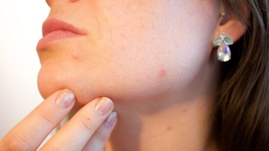 Preventions For Pimples: முகத்தில் தோன்றும் பல தொல்லைகளில் முதன்மையானது முகப்பரு, இது முகத்தில் தோன்றினால் தெளிவாக தெரியும். இக்காரணத்தினாலேயே பலர் முகப்பருவை போக்க பல வழிமுறைகளை பின்பற்றுவர்.