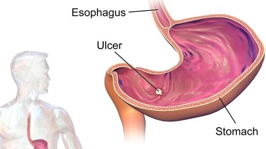 Ulcer Home Remedy : அல்சருக்கு அருமருந்தாகும். 11 நாட்கள் காலையில் வெறும் வயிற்றில் இந்த பானத்தை பருகிகனால் மட்டும் போதும். அல்சர் பறந்தோடும்.