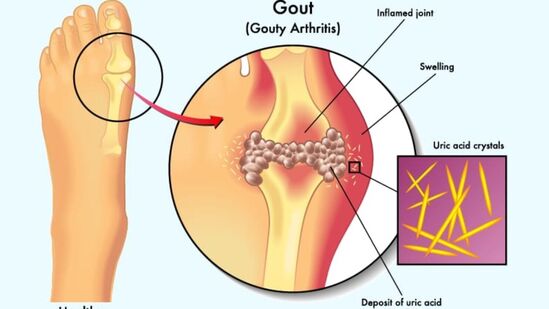 உங்கள் உடலில் யூரிக் அமிலம் அதிகரித்துவிட்டதா? பதறவேண்டாம்! அதை குறைக்க உதவும் 8 உணவுகள் எது? 