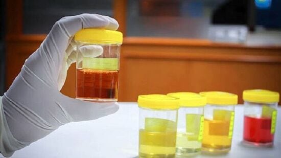 Urine Colour: சிறுநீர் நிறத்தை வைத்து உங்கள் உடலுக்குள் என்ன பாதிப்பு இருப்பதை அறியலாம்.. இதைக் கொஞ்சம் படிங்க! Urine Colour: சிறுநீர் நிறத்தை வைத்து உங்கள் உடலுக்குள் என்ன பாதிப்பு இருப்பதை அறியலாம்.. இதைக் கொஞ்சம் படிங்க!