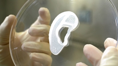 3D bioimplant of an earlobe
