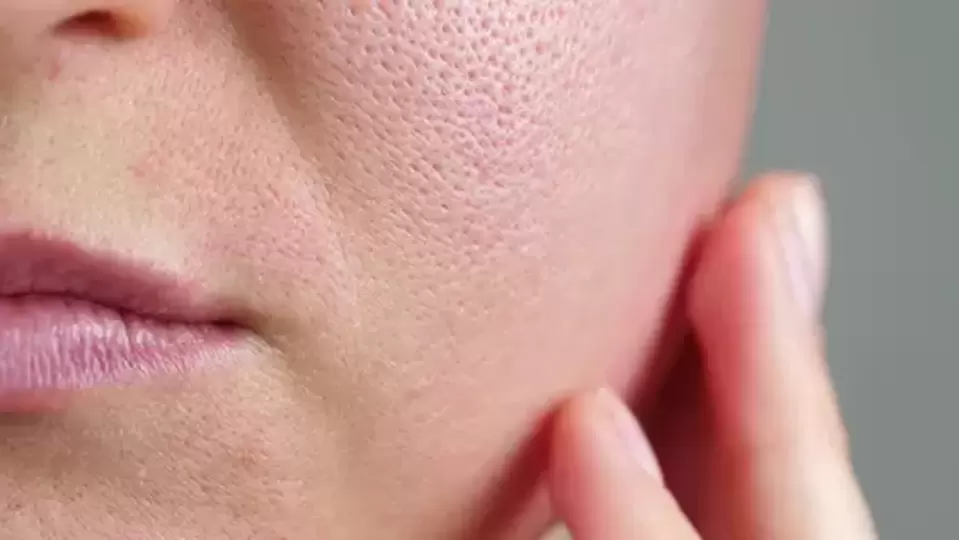 open-pores-shrink