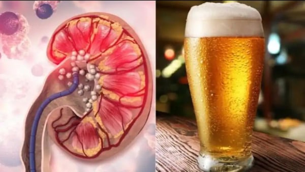 beer-for-kidney-stones