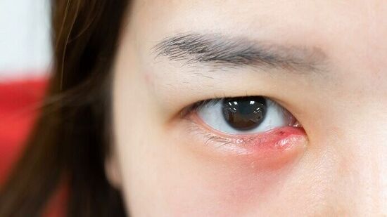 Eye Stye