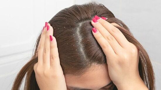 Home Treatments for Dandruff