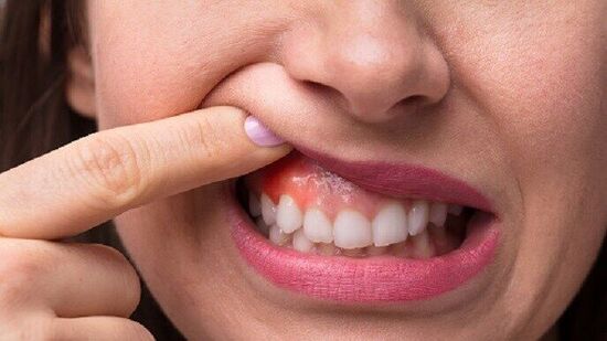 Bleeding Gums Home Remedies