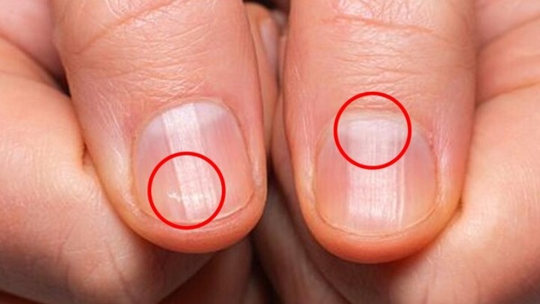 10 signs your nails need help - Times of India