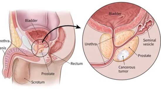ప్రోస్టేట్ క్యాన్సర్ - స్పెర్మ్‌ను రవాణా చేసే అవయవం ప్రోస్టేట్ గ్రంథి. &nbsp;మూత్ర విసర్జనలో ఇబ్బంది, మూత్ర విసర్జన ఎక్కువగా రావడం, మూత్రంలో రక్తం, వీర్యంలో రక్తం, ఎముకల నొప్పి, అంగస్తంభన లోపం... వంటి లక్షణాలు కనిపిస్తే వెంటనే వైద్యులను సంప్రదించాలి. ఇది ప్రొస్టేట్ క్యాన్సర్ లక్షణాలు.&nbsp;